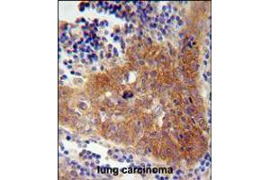 FBXW8 Antibody immunohistochemistry analysis in formalin fixed and paraffin embedded human lung carcinoma followed by peroxidase conjugation of the secondary antibody and DAB staining. (FBXW8 Antikörper  (AA 270-299))