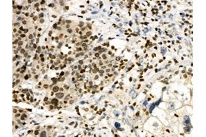 Phospho-HNF4 alpha (Ser304) Antibody at 1/100 staining Human ovarian cancer by IHC-P. (HNF4A Antikörper  (pSer304))
