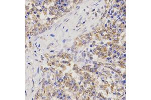 Immunohistochemistry of paraffin-embedded human lung cancer using TNFRSF1B antibody (ABIN6291033) at dilution of 1:200 (40x lens). (TNFRSF1B Antikörper)