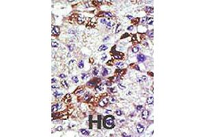 Formalin-fixed and paraffin-embedded human hepatocellular carcinoma tissue reacted with UBE2E3 polyclonal antibody  , which was peroxidase-conjugated to the secondary antibody, followed by AEC staining. (UBE2E3 Antikörper  (N-Term))