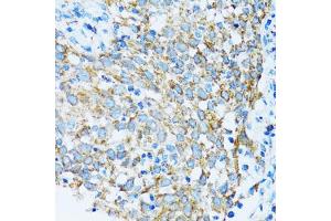 Immunohistochemistry of paraffin-embedded human lung cancer using PRDX3 antibody (ABIN5971574) at dilution of 1/100 (40x lens).