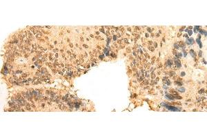 Immunohistochemistry of paraffin-embedded Human colorectal cancer tissue using CEP57 Polyclonal Antibody at dilution of 1:30(x200) (CEP57 Antikörper)