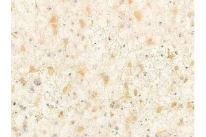 ABIN6262389 and ABIN6266906 at 1/100 staining human astrocytoma by IHC-P.
