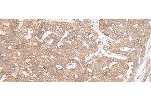 Immunohistochemistry of paraffin-embedded Human liver cancer tissue using PTP4A3 Polyclonal Antibody at dilution of 1:40(x200) (PTP4A3 Antikörper)