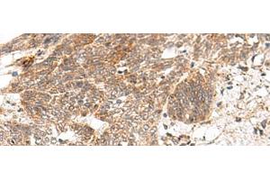 Immunohistochemistry of paraffin-embedded Human esophagus cancer tissue using GRASP Polyclonal Antibody at dilution of 1:150(x200)