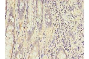 Immunohistochemistry of paraffin-embedded human colon cancer using ABIN7148658 at dilution of 1:100 (CKB Antikörper  (AA 2-270))