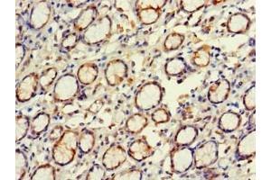 Immunohistochemistry of paraffin-embedded human gastric cancer using ABIN7152269 at dilution of 1:100 (EXD2 Antikörper  (AA 137-245))