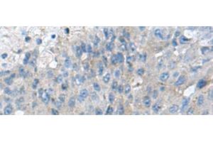 Immunohistochemistry of paraffin-embedded Human liver cancer tissue using KIAA0556 Polyclonal Antibody at dilution of 1:70(x200) (KIAA0556 Antikörper)