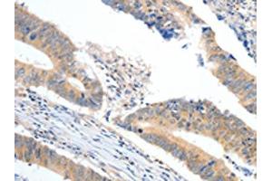 The image on the left is immunohistochemistry of paraffin-embedded Human colon cancer tissue using ABIN7189848(APOB Antibody) at dilution 1/10, on the right is treated with synthetic peptide. (APOB Antikörper)
