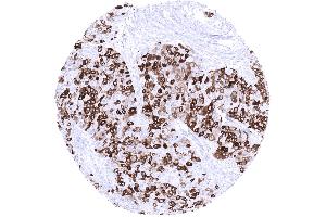 Breast Invasive breast cancer of no special type NST with variable mammaglobin immunostaining in tumor cells mosaic pattern (Rekombinanter Mammaglobin Antikörper)