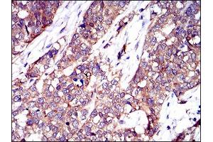 Immunohistochemical analysis of paraffin-embedded ovarian cancer tissues using TWF1 antibody with DAB staining. (TWF1 Antikörper  (AA 335-384))