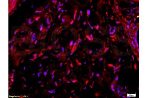 Formalin-fixed and paraffin-embedded human colon carcinoma labeled with Anti-Collagen V Polyclonal Antibody, Unconjugated (ABIN669996) 1:200 followed by conjugation to the secondary PE antibody and DAB staining (Collagen Type V Antikörper  (AA 1450-1500))