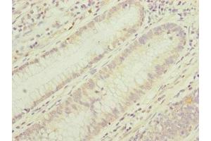 Immunohistochemistry of paraffin-embedded human colon cancer using ABIN7159903 at dilution of 1:100 (TIMM17B Antikörper  (AA 1-172))