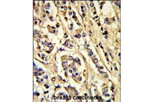 Formalin-fixed and paraffin-embedded human breast carcinoma reacted with VGFR2 Antibody, which was peroxidase-conjugated to the secondary antibody, followed by DAB staining. (VEGFR2/CD309 Antikörper)
