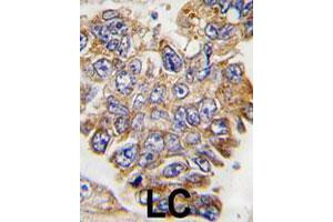 Formalin-fixed and paraffin-embedded human lung carcinoma tissue reacted with GRB2 polyclonal antibody  , which was peroxidase-conjugated to the secondary antibody, followed by DAB staining.
