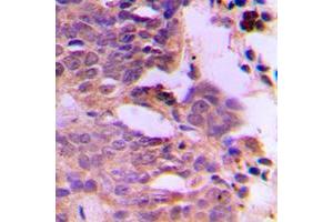 Immunohistochemical analysis of SIAH1/2 staining in human breast cancer formalin fixed paraffin embedded tissue section. (SIAH1/2 Antikörper  (Center))