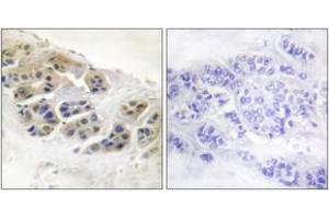 Immunohistochemistry analysis of paraffin-embedded human breast carcinoma tissue, using Mammaglobin Antibody. (Mammaglobin Antikörper  (AA 41-90))