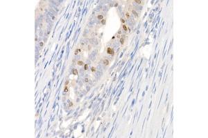 Immunohistochemistry of paraffin-embedded human colon carcinoma using Survivin Rabbit pAb (ABIN6132229, ABIN6137562, ABIN6137563 and ABIN6218613) at dilution of 1:100 (40x lens). (Survivin Antikörper  (AA 1-142))