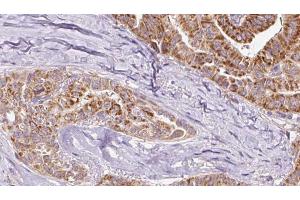 ABIN6267080 at 1/100 staining Human thyroid cancer tissue by IHC-P. (Connexin 43/GJA1 Antikörper  (pTyr265))