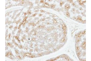 IHC-P Image Immunohistochemical analysis of paraffin-embedded human breast cancer, using ADPGK, antibody at 1:250 dilution. (ADPGK Antikörper)