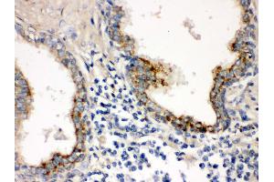 IHC(P): Human Prostatic Cancer Tissue