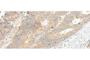 Immunohistochemistry of paraffin-embedded Human colorectal cancer tissue using GPR12 Polyclonal Antibody at dilution of 1:35(x200) (G Protein-Coupled Receptor 12 Antikörper)