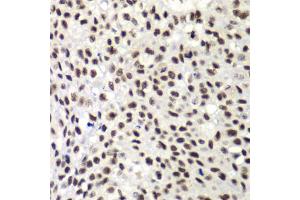 Immunohistochemistry of paraffin-embedded human lung cancer using NELFE antibody (ABIN6289947) at dilution of 1:100 (40x lens). (RDBP Antikörper)