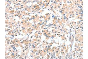The image on the left is immunohistochemistry of paraffin-embedded Human thyroid cancer tissue using ABIN7128970(CLIP1 Antibody) at dilution 1/30, on the right is treated with fusion protein. (CLIP1 Antikörper)