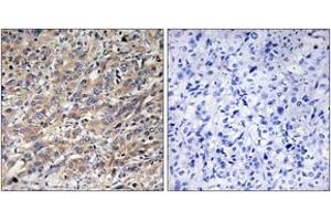 Immunohistochemistry analysis of paraffin-embedded human liver carcinoma tissue, using COX17 Antibody. (COX17 Antikörper  (AA 1-50))