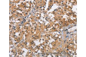 Immunohistochemistry of Human thyroid cancer using BRE Polyclonal Antibody at dilution of 1:40 (BRE Antikörper)
