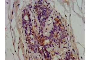 IHC image of ABIN7145566 diluted at 1:600 and staining in paraffin-embedded human breast cancer performed on a Leica BondTM system. (EPRS Antikörper  (AA 1207-1399))