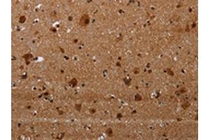 The image on the left is immunohistochemistry of paraffin-embedded Human brain tissue using ABIN7191356(MAGEE1 Antibody) at dilution 1/30, on the right is treated with synthetic peptide. (MAGEE1 Antikörper)