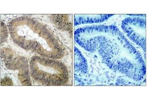 Immunohistochemical analysis of paraffin-embedded human colon carcinoma tissue using IKK a(Phospho-Thr23) Antibody(left) or the same antibody preincubated with blocking peptide(right). (IKK alpha Antikörper  (pThr23))