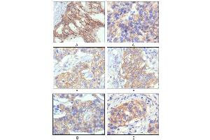 Immunohistochemical analysis of paraffin-embedded human breast intraductal carcinama tissue(A) and breast infiltrating ductal carcinama tissue(B) showing membrane localization using HER-2 mouse mAb with DAB staining.