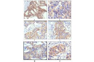 Immunohistochemical analysis of paraffin-embedded human breast intraductal carcinama tissue(A) and breast infiltrating ductal carcinama tissue(B) showing membrane localization using HER-2 mouse mAb with DAB staining. (ErbB2/Her2 Antikörper)