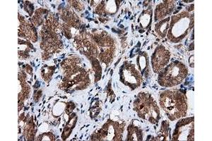 Immunohistochemical staining of paraffin-embedded Adenocarcinoma of ovary tissue using anti-AKR1A1 mouse monoclonal antibody. (AKR1A1 Antikörper)
