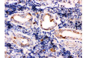 TPP1 was detected in paraffin-embedded sections of human lung cancer tissues using rabbit anti- TPP1 Antigen Affinity purified polyclonal antibody at 1 μg/mL.