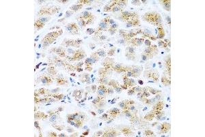 Immunohistochemistry of paraffin-embedded human liver cancer using KIAA1456 antibody at dilution of 1:200 (40x lens). (KIAA1456 Antikörper)