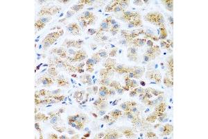Immunohistochemistry of paraffin-embedded human liver cancer using KIAA1456 antibody at dilution of 1:200 (40x lens).