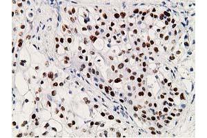 Immunohistochemical staining of paraffin-embedded Carcinoma of Human pancreas tissue using anti-TP53 mouse monoclonal antibody. (p53 Antikörper)