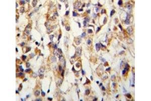 IHC analysis of FFPE human breast carcinoma with Keratin-14 antibody (KRT14 Antikörper  (AA 276-303))