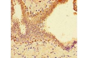 Immunohistochemistry of paraffin-embedded human prostate cancer using ABIN7172704 at dilution of 1:100 (SUPT3H/SPT3 Antikörper  (AA 1-328))