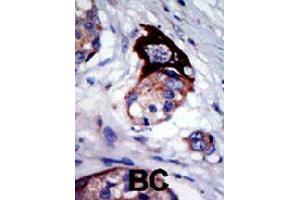Formalin-fixed and paraffin-embedded human cancer tissue reacted with MARK3 polyclonal antibody  , which was peroxidase-conjugated to the secondary antibody, followed by AEC staining. (MARK3 Antikörper  (C-Term))