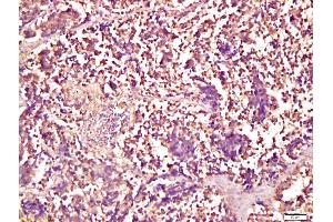 Formalin-fixed and paraffin embedded human lung carcinoma labeled with Anti-Smad1 Polyclonal Antibody, Unconjugated (ABIN732158) at 1:200 followed by conjugation to the secondary antibody and DAB staining (Smad1/5 Antikörper  (AA 361-465))