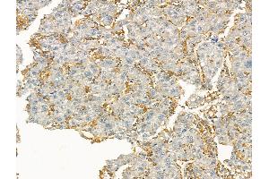 ABIN7094421 and ABIN7098468 at 1/100 staining Human liver cancer by IHC-P.