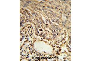 Formalin-fixed and paraffin-embedded human lung carcinoma reacted with EIF4A2 Antibody (C-term), which was peroxidase-conjugated to the secondary antibody, followed by DAB staining. (EIF4A2 Antikörper  (C-Term))