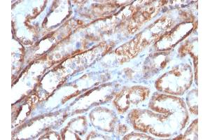 Formalin-fixed, paraffin-embedded human Renal Cell Carcinoma stained with Mitochondria Monoclonal Antibody (MTC719) (Mitochondrial Marker Antikörper)