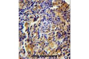 CK073 Antibody (N-term) immunohistochemistry analysis in formalin fixed and paraffin embedded human lung carcinoma followed by peroxidase conjugation of the secondary antibody and DAB staining. (C11orf73 Antikörper  (N-Term))
