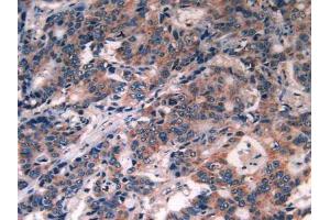 IHC-P analysis of Human Rectum Cancer Tissue, with DAB staining. (PDGFRA Antikörper  (AA 170-387))