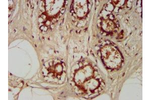 IHC image of ABIN7172365 diluted at 1:400 and staining in paraffin-embedded human breast cancer performed on a Leica BondTM system. (TRAPPC6A Antikörper  (AA 1-173))